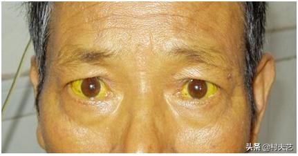 中医判断疾病的4种方法,中医症状鉴别