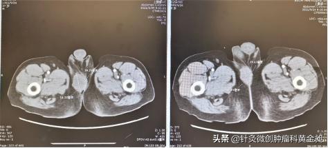 直肠癌患者的难言之隐：肛门会阴区转移