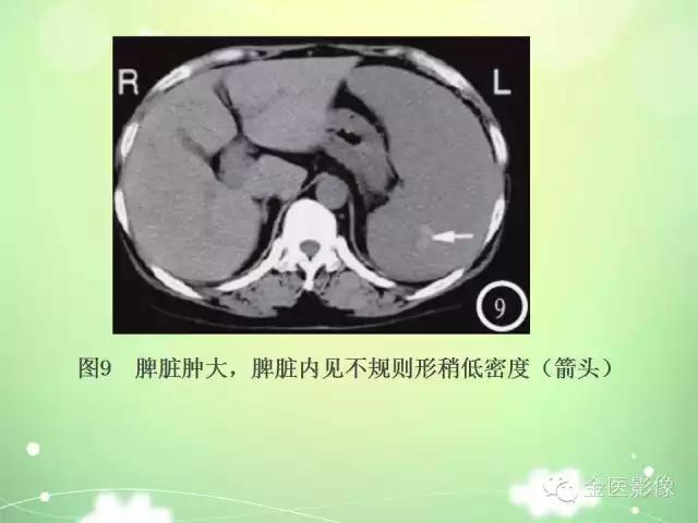脾血管瘤中医辨证,脾血管瘤超声表现