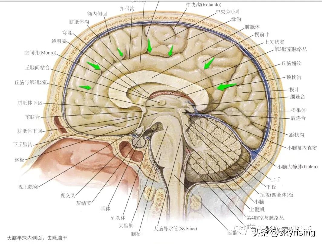 半叶全前脑畸形,无叶型前脑无裂畸形超声表现