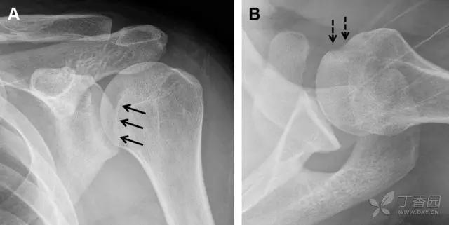 值夜班急救措施,放射科容易漏诊的骨折