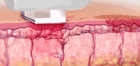 脸部黑黄暗淡做什么医美,脸部肤色不均匀做什么医美