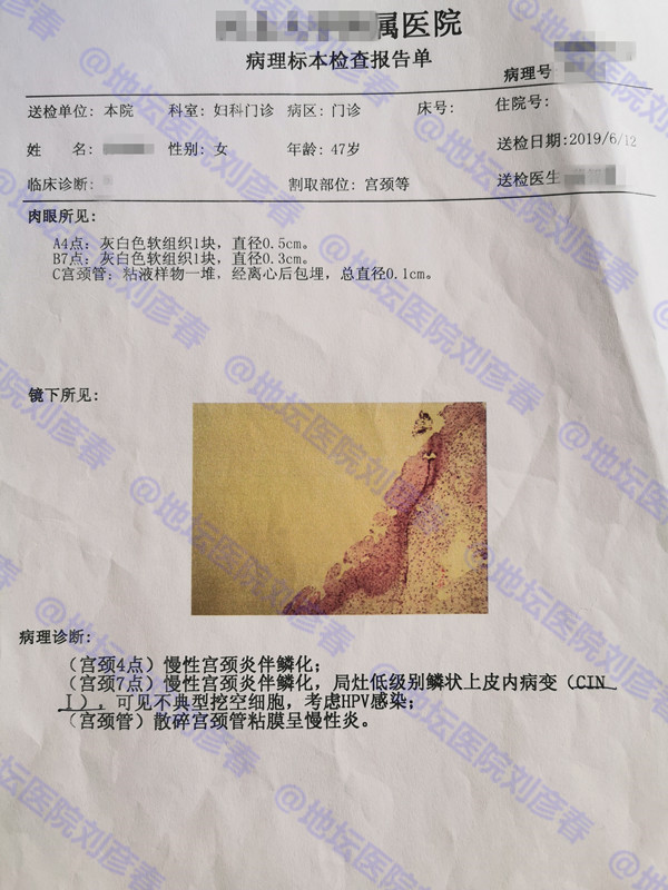 微创热凝杀毒剥脱术是什么手术,微创热凝杀毒剥脱术价格