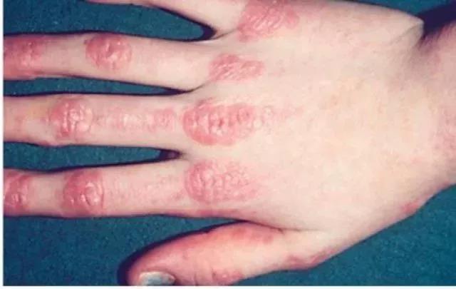 儿童皮肌炎的发病原因,儿童皮肌炎预后