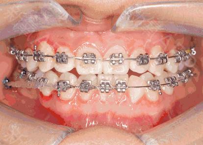 30岁了还可以做牙齿矫正吗,30岁还可以做牙齿矫正吗