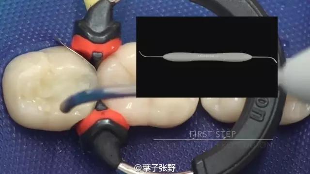 补牙疼吗补牙过程图,补牙全部过程是什么样子的