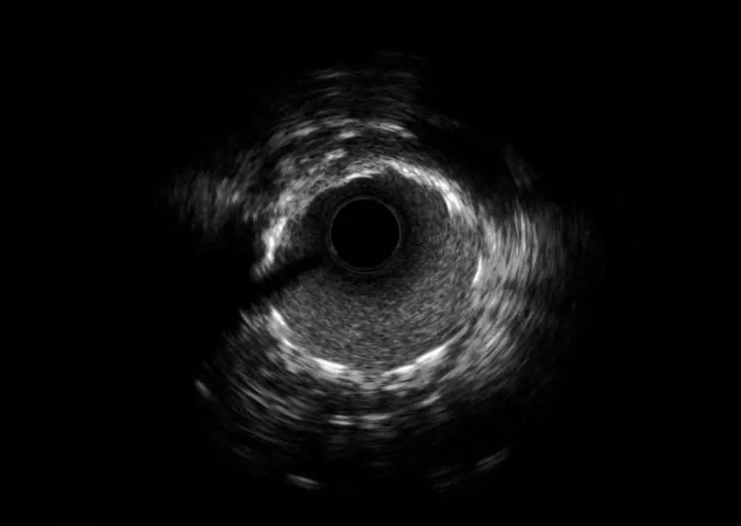 心内科冠状动脉造影术,北医三院介入超声