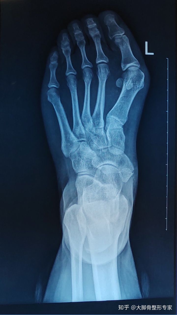 女生为什么会有大脚骨和小脚骨,大脚骨和小脚骨突出怎么办呢