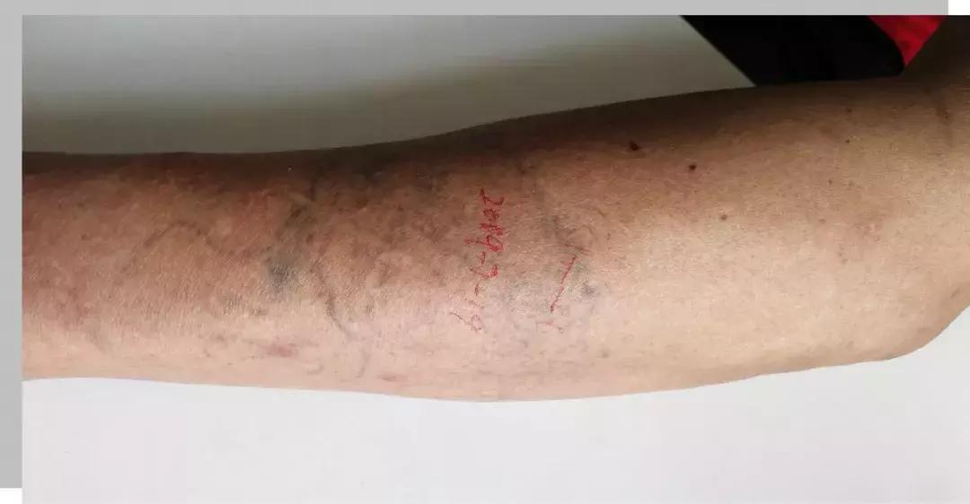 留置针导管会折断血管吗,留置针导管会折断吗