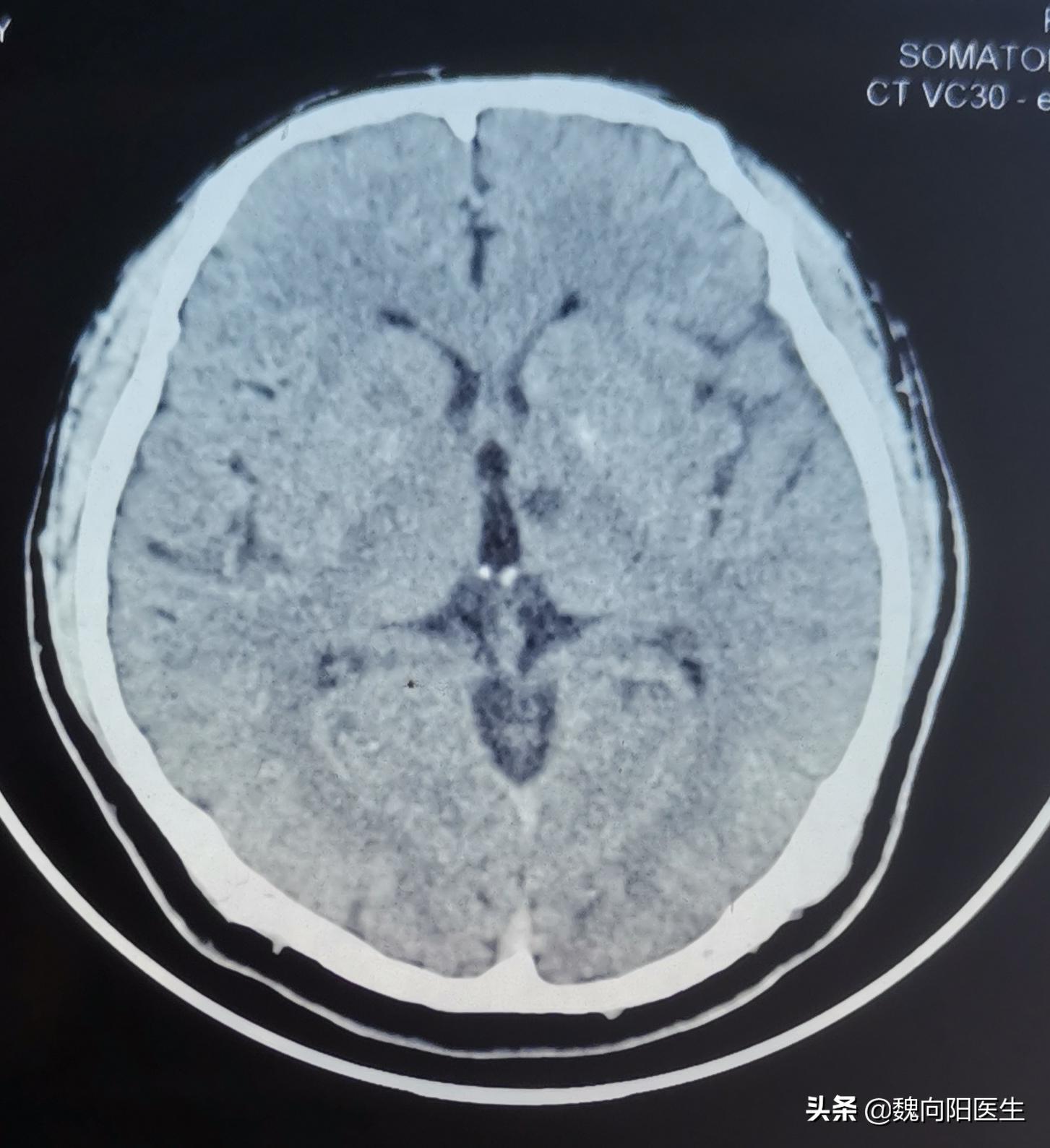 腔隙性脑梗死需住院治疗吗,腔隙性脑梗死需要住院治疗吗