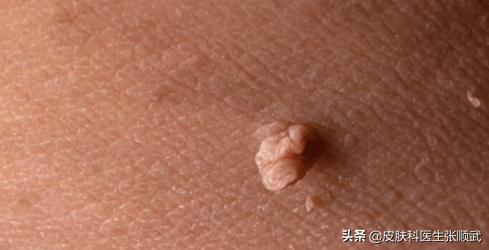 皮肤上长小肉球,身体上长小肉粒能用头发去掉吗