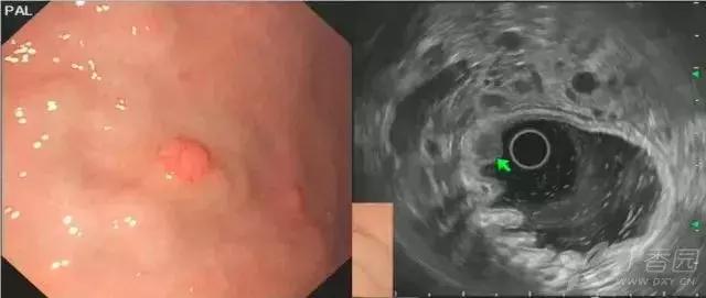 超声胃镜粘膜下隆起低回声占位,胃镜显示食道粘膜下隆起5mm