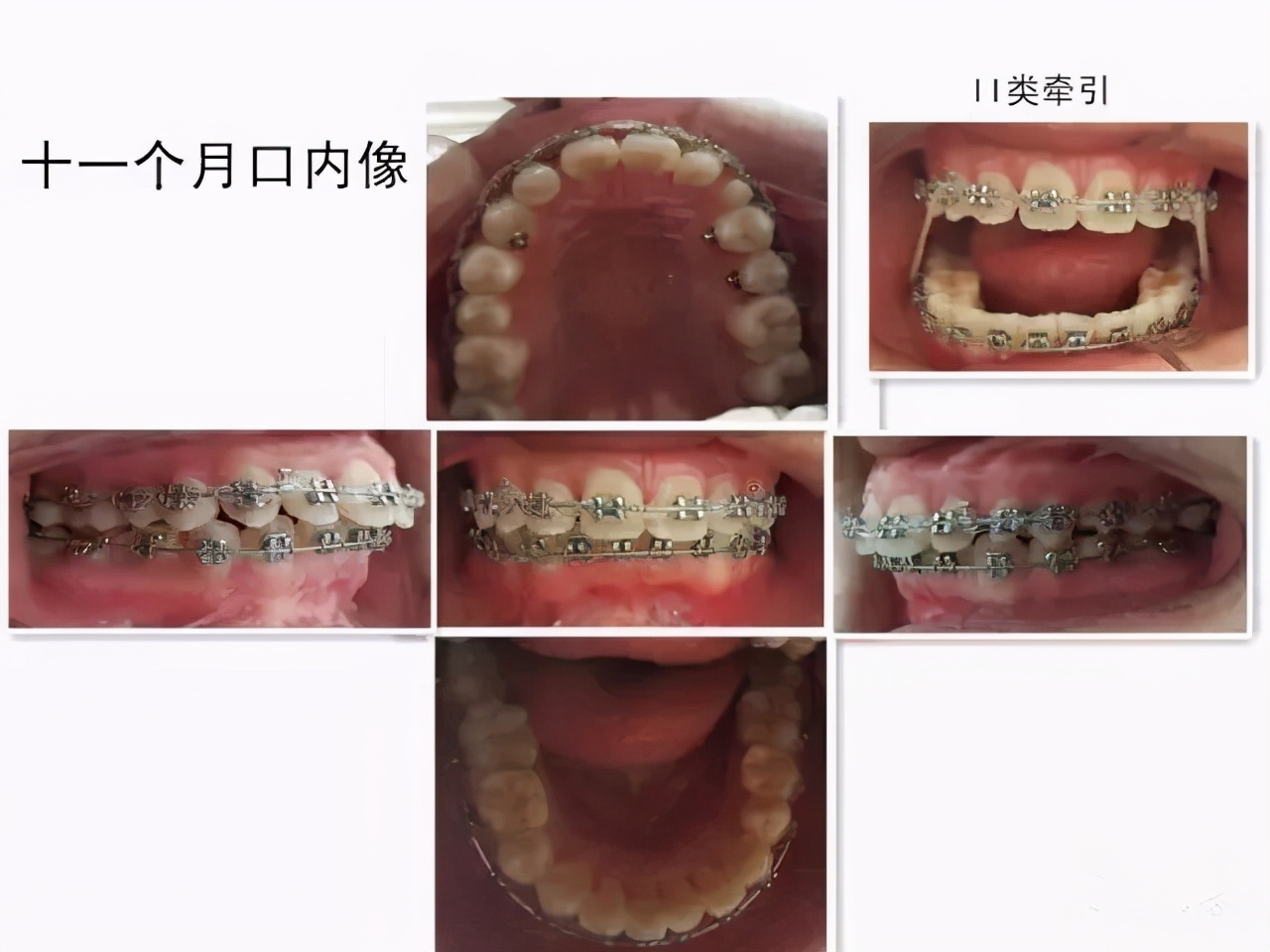 成年人牙齿矫正戴上牙套嘴巴变凸,扩弓会使脸型变大吗