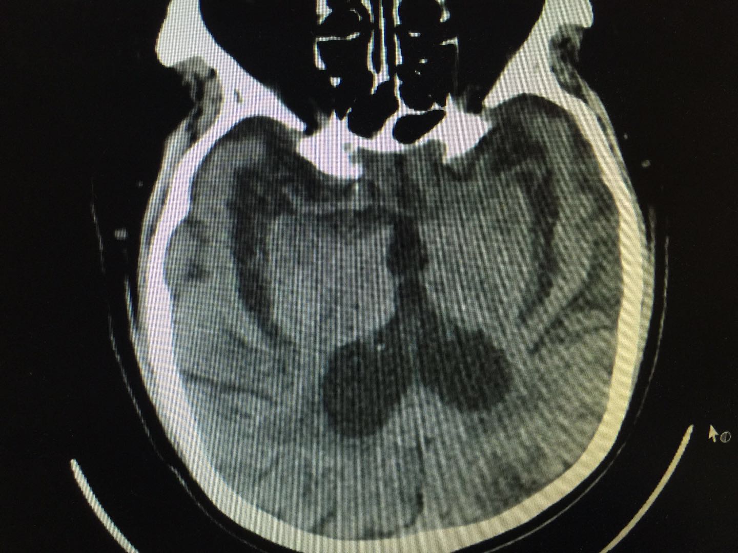 脑萎缩和小脑萎缩哪个危害大,脑萎缩和脑梗有什么区别吗