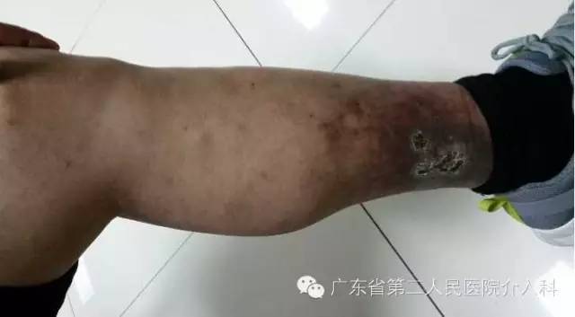 左腿血栓肿胀能完全恢复正常吗,左腿血栓肿痛怎么锻炼