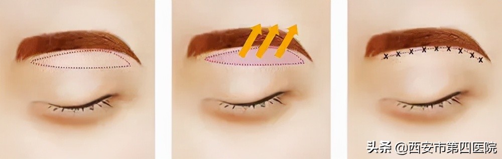 提眉术后注意事项及禁忌,提眉术能改善哪些问题