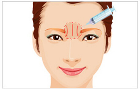 法令纹川字纹额头皱纹哪个更显老,男人女人如何去掉显老的川字纹