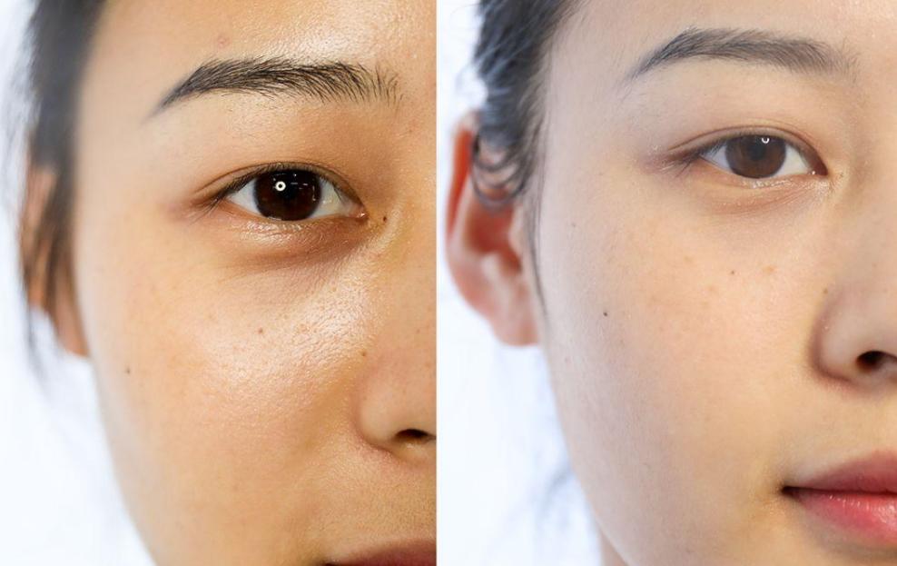 眼袋黑眼圈最好的解决方法,眼袋加黑眼圈最好的解决办法