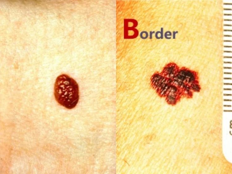 辟谣丨激光点痣不可取,小心“点”出恶性黑色素瘤！5步判断恶性痣