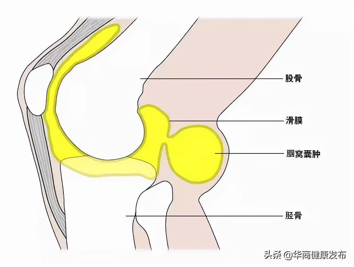 膝盖腘窝囊肿多大要手术,腘窝手术切口