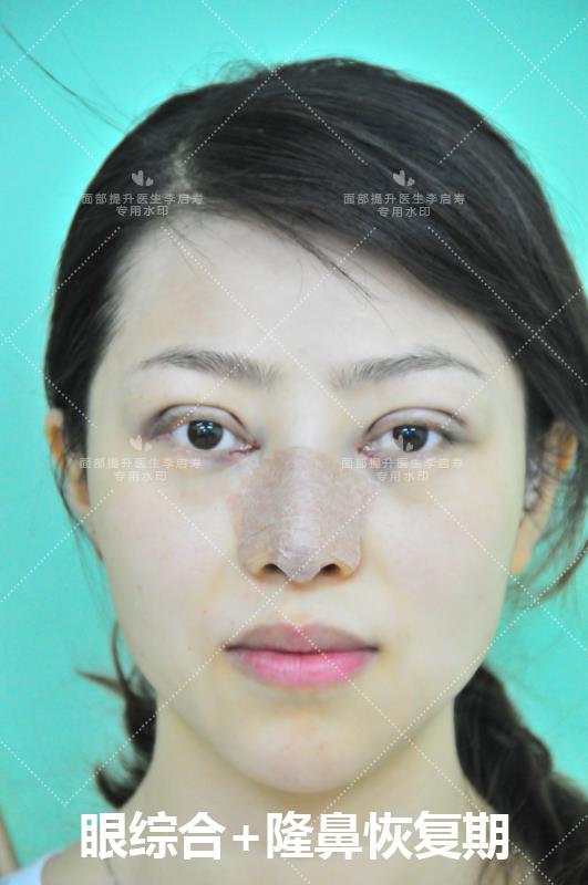 谈谈自己的整形经历,整形过来人经验分享