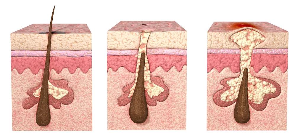 辟谣、吃酱油加深痘印?芦荟胶治好痘坑?别傻了!