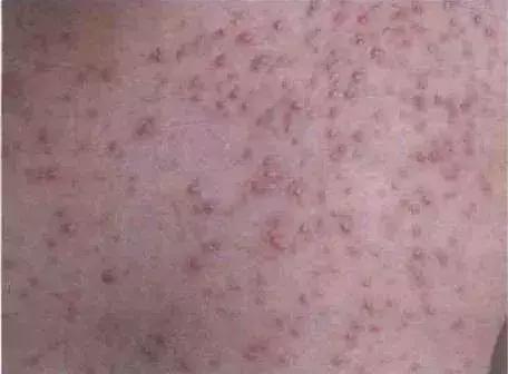 治疗真菌性皮肤病的中药方子,真菌皮肤病的书籍