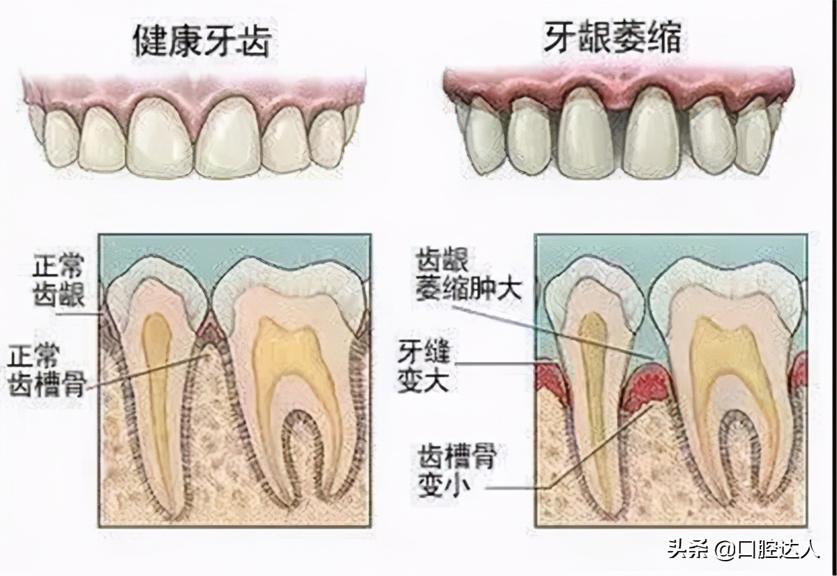 牙缝大是牙冠矫正还是贴面,牙齿贴面补牙缝多少钱
