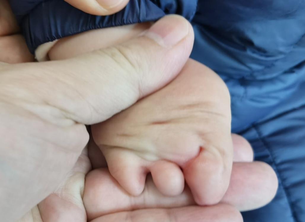 并指畸形免植皮案例,并指畸形