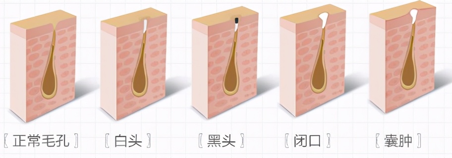 脸上长闭口怎么办有效的去除,脸上老是长闭口粉刺怎么调理