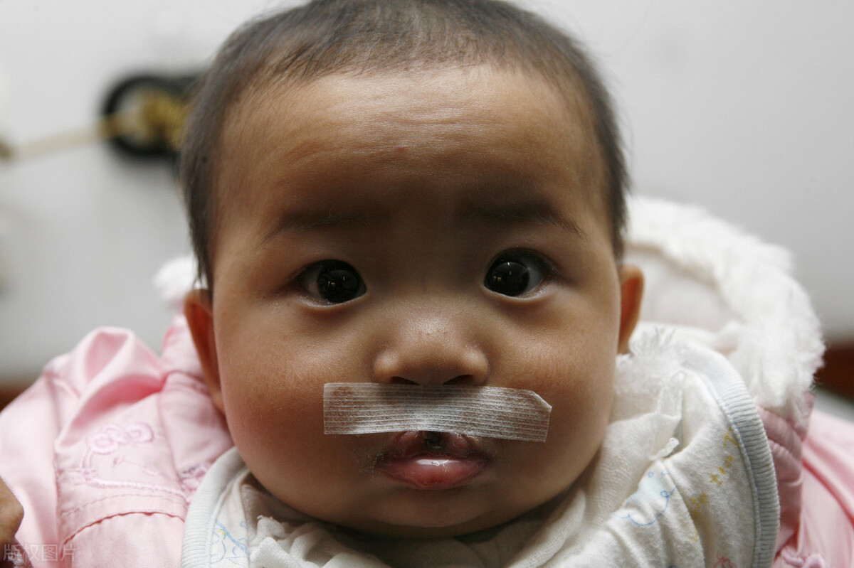 腭裂语音训练最新方法,腭裂手术多久可以语言训练