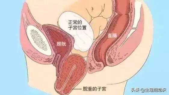 阴道里脱出块“肉”！