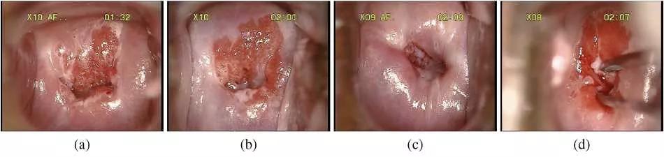 在AI消灭宫颈癌这件事情上，腾讯天衍实验室做了一些重磅研究