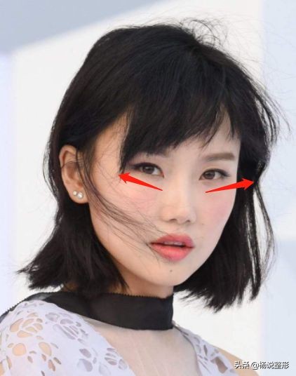 整形医生科普割双眼皮必看攻略,割双眼皮一定好看吗