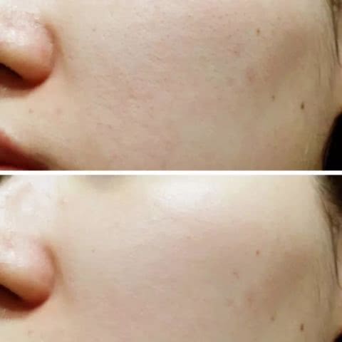 淡斑祛痘印什么产品最有效,淡斑美白祛痘印