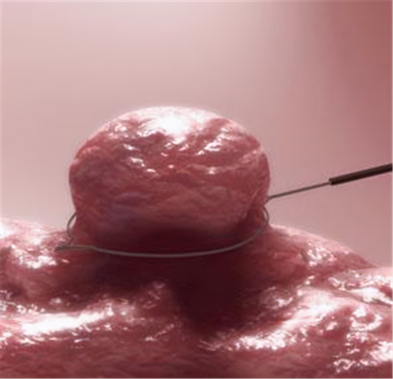 做胃镜发现有息肉建议切除吗,做胃镜发现息肉可以直接切除吗