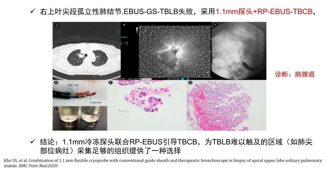 经皮肺穿刺活检术过程,经支气管冷冻肺活检