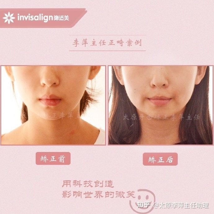 太原牙齿矫正靠谱吗,太原成人隐形牙套牙齿不齐