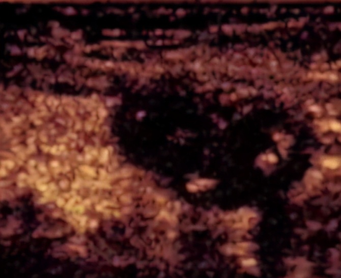 甲状腺结节微波消融术,厦门有微波消融术治疗甲状腺结节