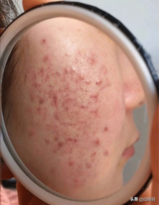 过度护肤导致角质层受损怎么修复,护肤品真能修护角质层吗