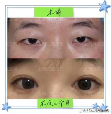 双眼皮VS单眼皮，为什么更多人喜欢双眼皮？