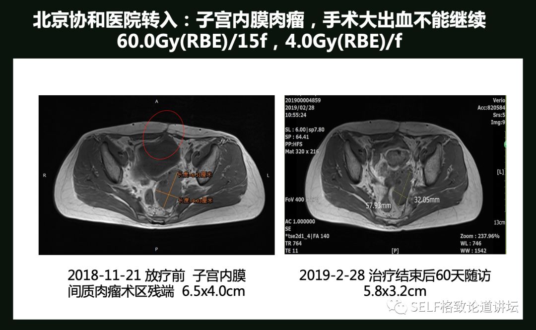 这个装置成功辅助我国两弹爆炸，现在它能治疗肿瘤
