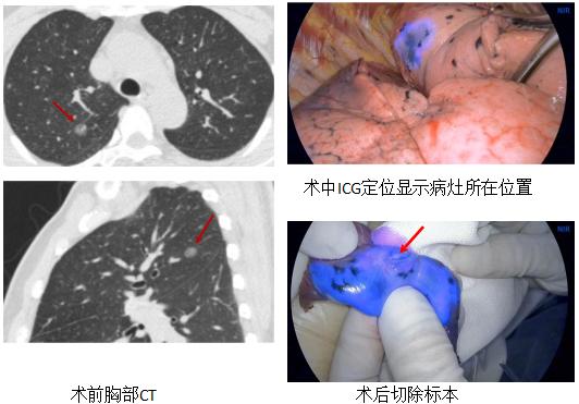 孙加源门诊,治疗肺癌的新技术新手段