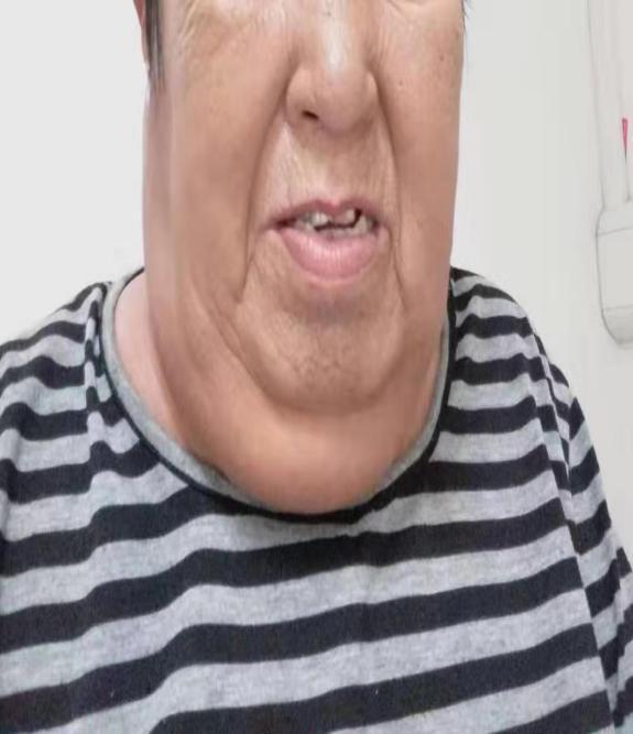 透析患者上肢肿胀原因及处理,血液透析并发症及处理