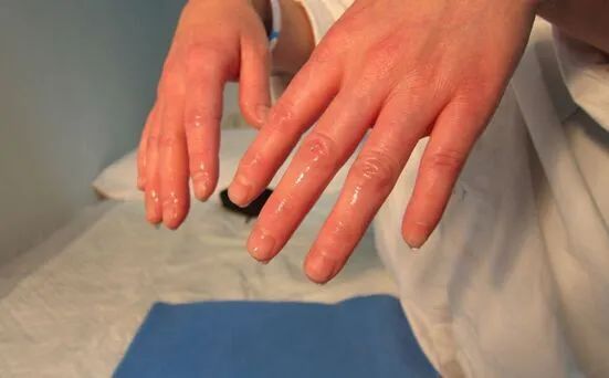 手汗不是很多怎么回事,手汗多是一种病吗怎么治