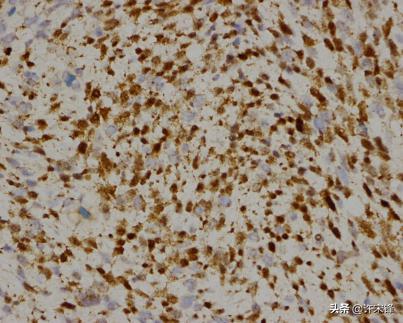 胚胎横纹肌肉瘤是怎么形成的,横纹肌肉瘤转移全身能活多久