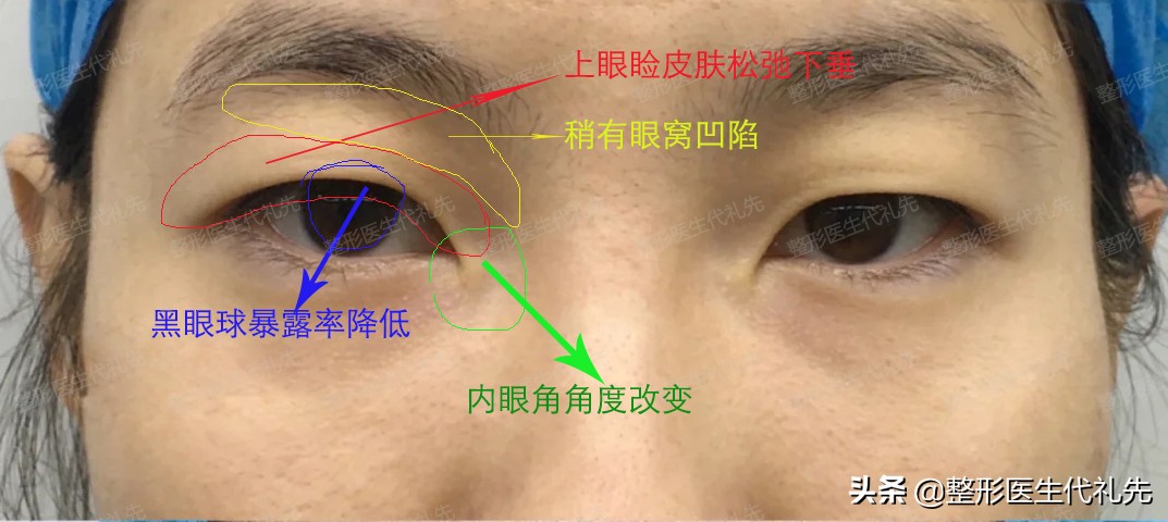 年轻眼睑松弛可以恢复吗,年纪大了眼皮松弛单眼皮变双眼皮