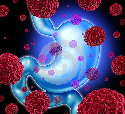 老年人胃溃疡是什么引起,老年人胃溃疡是什么原因引起的啊