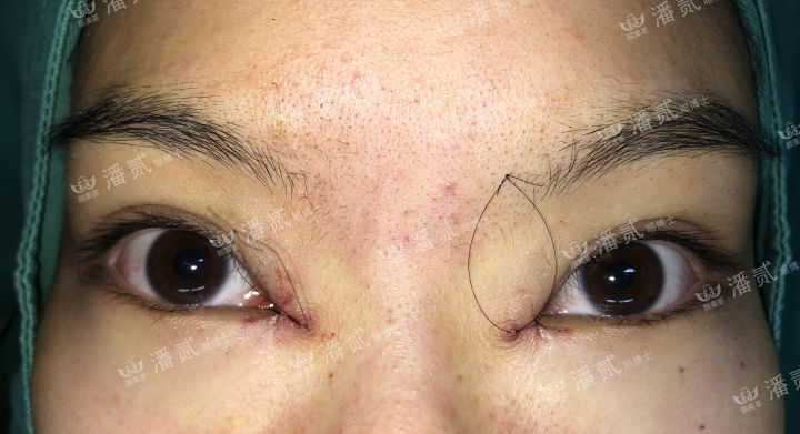 女孩眼部整形失败,内眼角整形失败