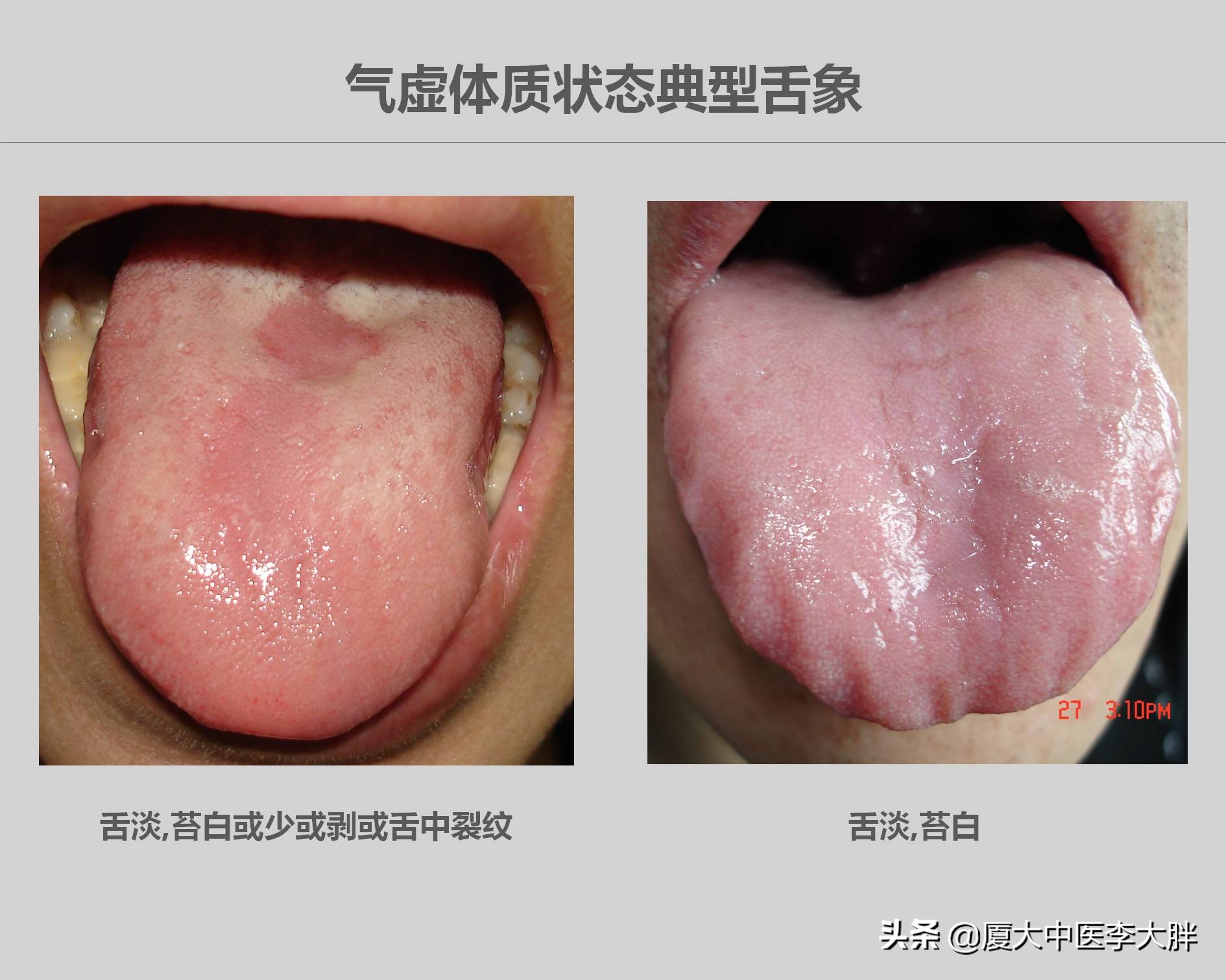 体虚多汗浑身乏力怎么调理,困乏多汗气虚怎么办